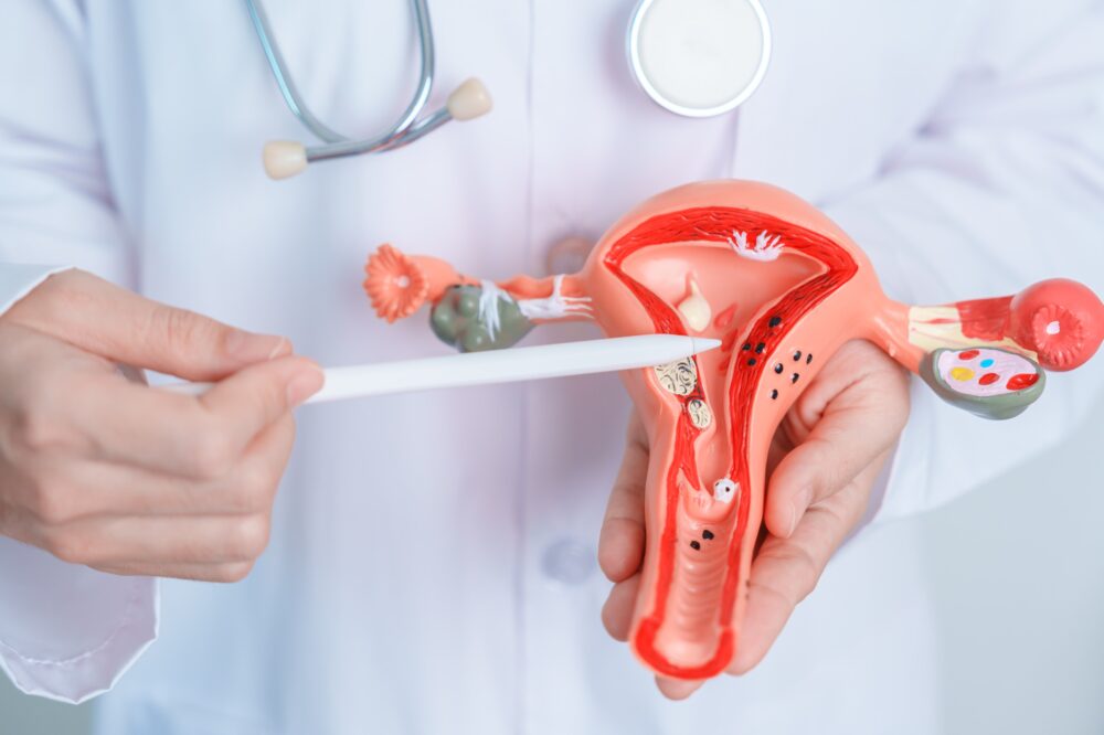 ¿Cómo reconocer y reducir el riesgo de ser diagnosticada con Cáncer de Ovario?